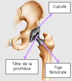 Prothèse de hanche