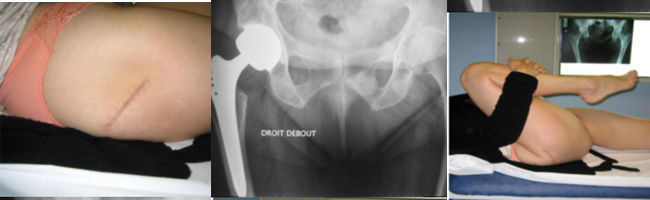 Prothèse de hanche posée par voie mini-invasive (7cm) avec une flexion de hanche >120°